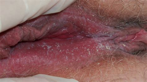 pictures of anal sores other xxx photos