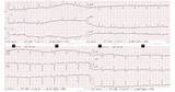 Bradycardia Supraventricular Rhythms Ecg Rhythm Sinus Patient sketch template