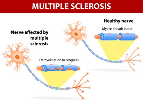 natural relief  symptoms  multiple sclerosis  sacramento body balance spinal care