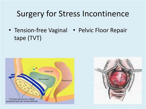 ppt management of urinary incontinence powerpoint presentation free