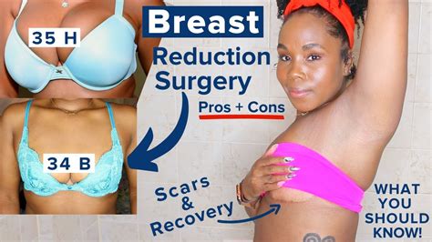 my breast reduction breast lift and recovery story scars dark marks