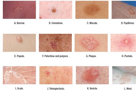 medical addicts terms   describe skin lesions