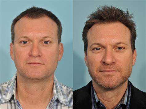 hair transplant before and after 2 jesse e smith md facs ft worth