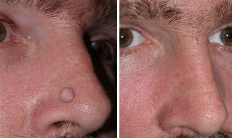 facial mole removal seatle area porn pics and moveis