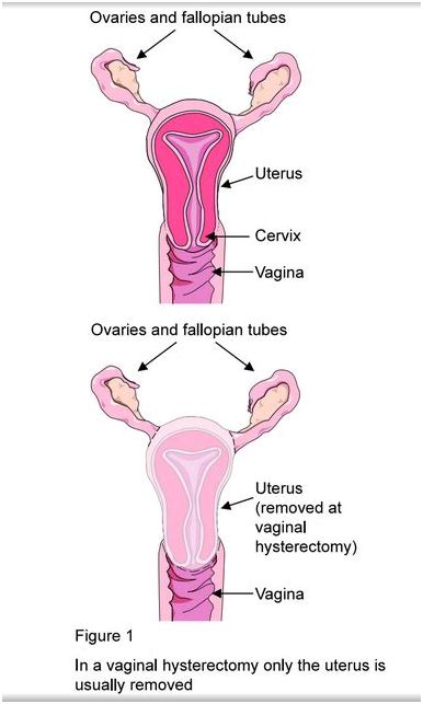 Hysterectomy Vaginal Parkside Hospital