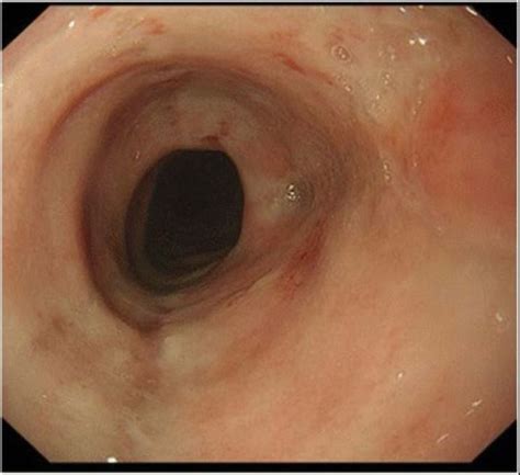 Esophagitis Concise Medical Knowledge