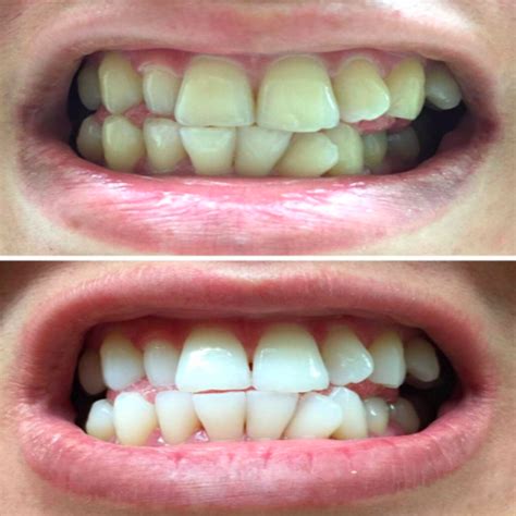 best whitening strips for yellow teeth teeth poster