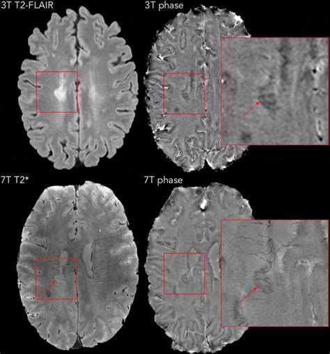 Identification Of Chronic Active Multiple Sclerosis Lesions On 3t Mri