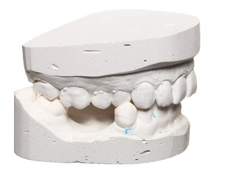 muffa dentaria del modello del gesso dei denti  gesso fotografia stock immagine  zirconio