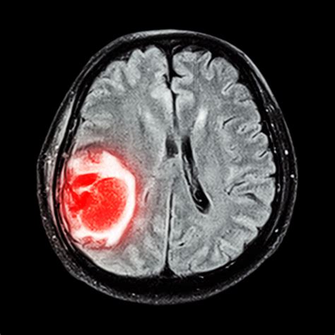 brain tumor symptoms     head university health news