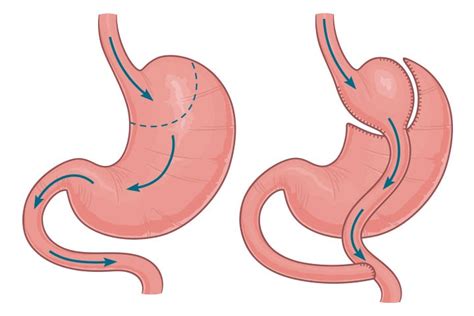 gastric bypass tops banding  td remission medpage today