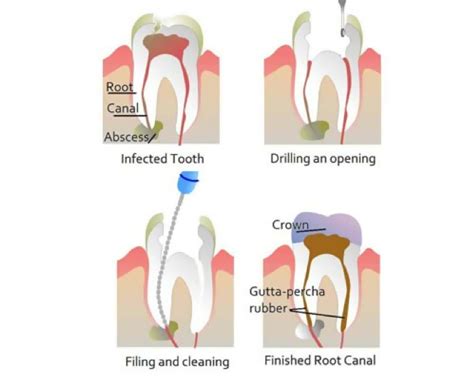 I Have A Failed Root Canal What Do I Do Best Root Canal Specialist Nyc