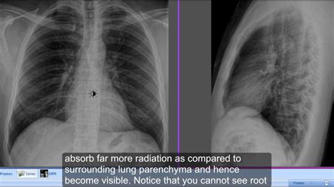 Differentiate Left And Right Hemidiaphragms On Chest X Ray