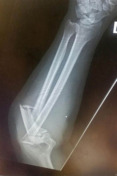 girl  horrifically disfigured broken arm   drunk  laughs  fracture world news