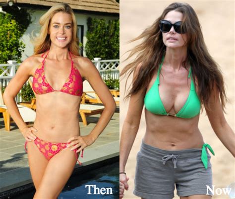Denise Richards Plastic Surgery Before And After Photos
