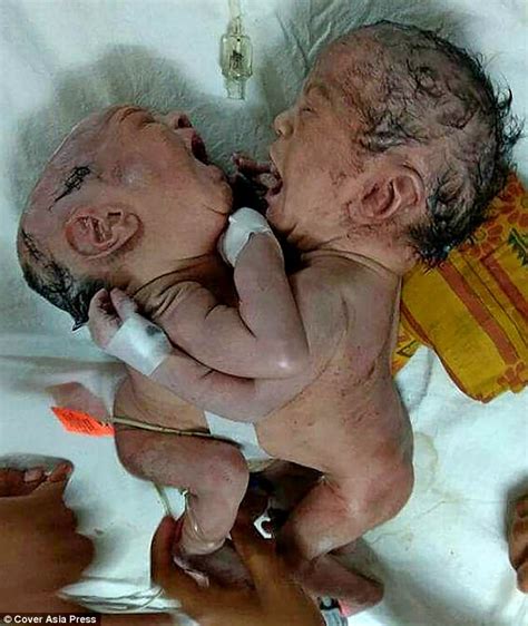 Indian Woman Gives Birth To Twins Conjoined At The Abdomen Daily Mail
