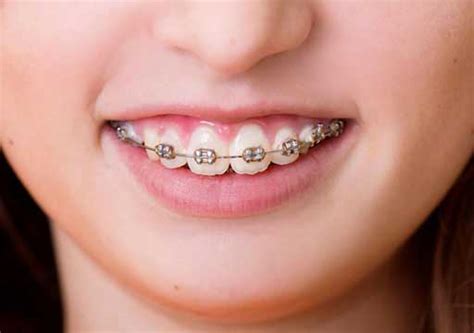 factors to consider in deciding which type of braces is right for you