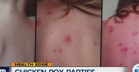 Chicken Pox Parties Causing Controversy