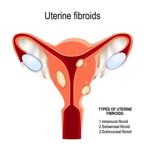 can fibroids affects your fertility