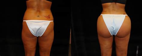 patient 775 brazilian butt lift before and after photos