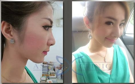 thailand plastic surgery rhinoplasty nose surgery