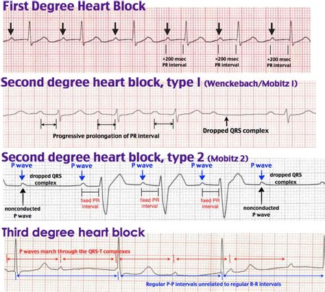 st degree  degree st degree  degree heart block ecg  idea