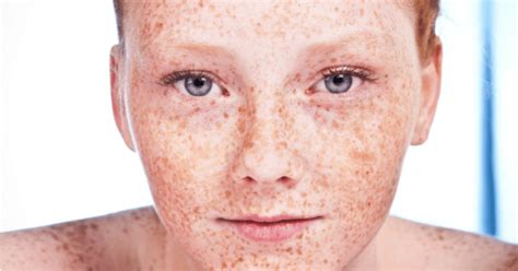 10 freckle facts only the freckled know to be true