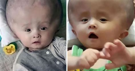baby suffers  huge head   wont stop growing daily star