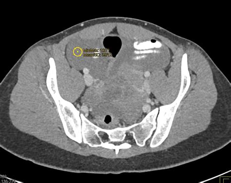 ruptured ovarian cyst ct scan ct scan machine