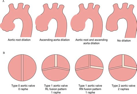 Determinants Of Aortic Growth Rate In Patients With Bicuspid Aortic