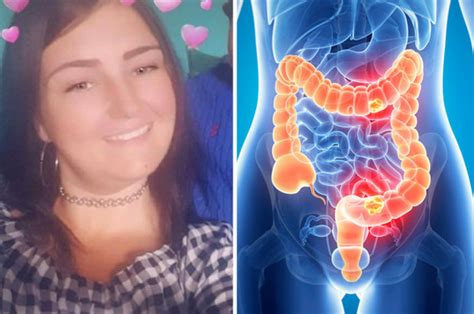 Woman Dies After Doctors Confuse Cancer With Ibs Here Are The Signs