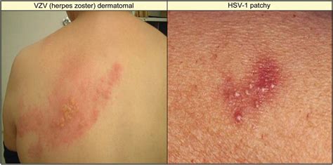 Herpes Zoster Virus 1 Or 2 — Herpes Free Me