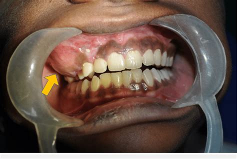 intraoral view showing  swelling obliterating  upper  buccal  scientific