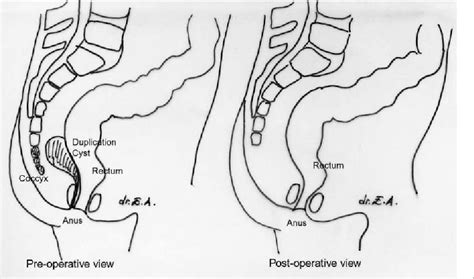 figure 4 from rectal duplication as an unusual cause of chronic