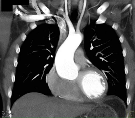 dilated aortic root  marfan syndrome vascular case studies ctisus