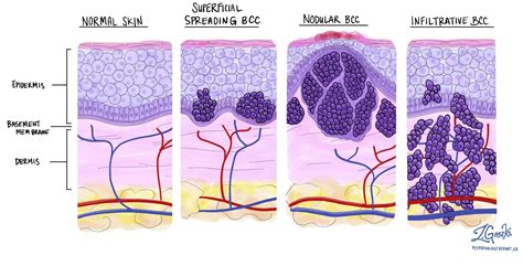 skin cancer cells types
