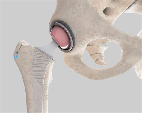 minimally invasive anterior approach total hip replacement doctor