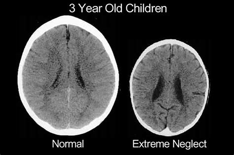 brain scans reveal  badly emotional abuse damages kids