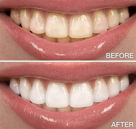 bleaching unique dental care rajkot orthodontic treatment dr agheras hospital dr