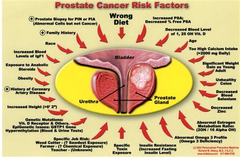 What Organs Does Prostate Cancer Spread To Prostateprohelp Hot Sex