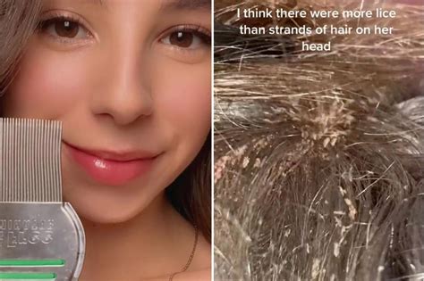 i kill head lice for a living — how to avoid infestation
