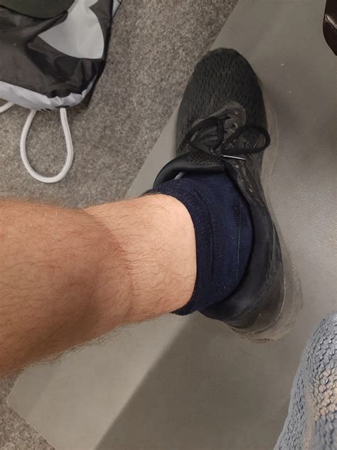 Obesity Hill Commentator Tight Socks Cause Swelling Join Scarp Slim