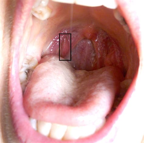 swelling inside the throat hard orgasm