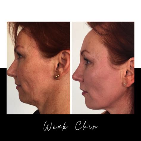 weak chin   results  surgery