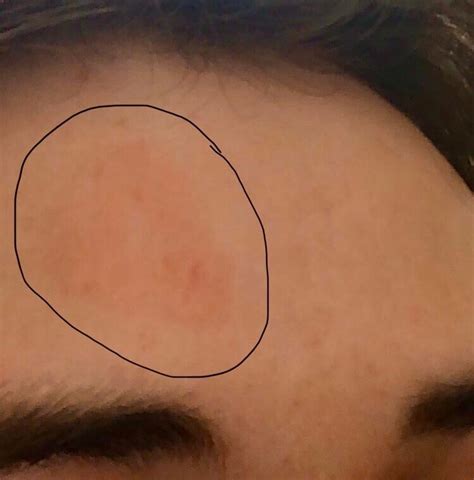red mark   forehead