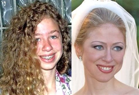 Chelsea Clinton Plastic Surgery Before And After Nose Job Pictures
