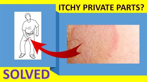 how to cure itching near private parts itchy groin area home remedy
