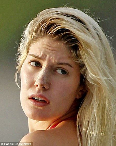heidi montag fears her nose may fall off like michael