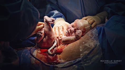 C Section Birth Photographs What To Expect