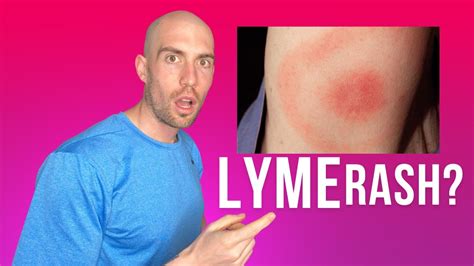 Lyme Disease Rash What Is And Is Not How To Tell Youtube